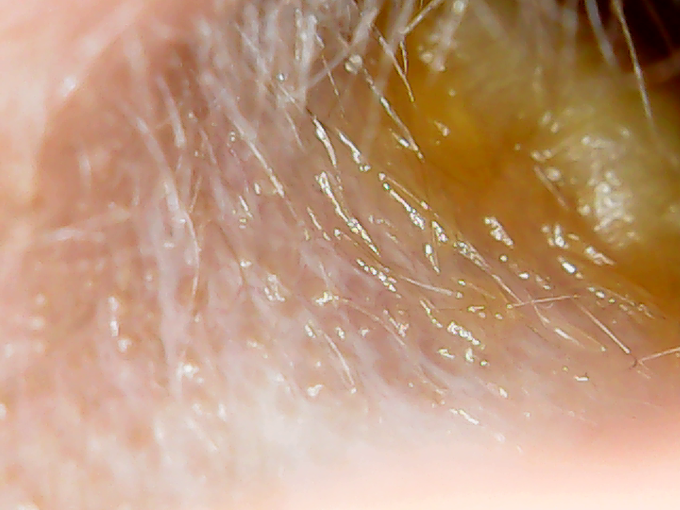 microscope-ear-canal