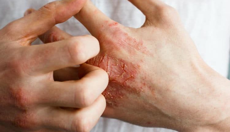Časté umývanie rúk je peklom pre suché ruky: Je krémovanie bezpečné?