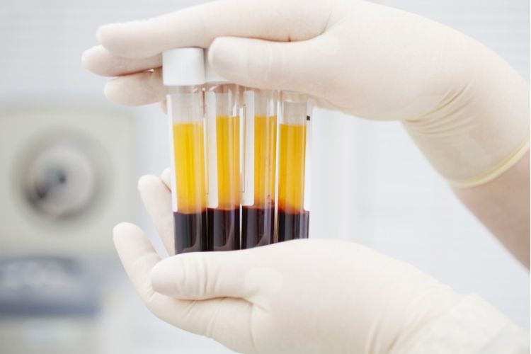 Českí lekári podali pacientovi s Covid-19 krvnú plazmu vyliečenej osoby